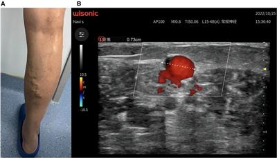 Case report: Use of laparoscopic electrocoagulation rods in endovenous thermal ablation of saphenous trunks in the treatment of varicose veins of the lower extremities